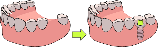 歯を1本失った場合のインプラント
