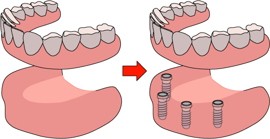歯をすべて失った場合のインプラント