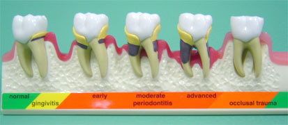 歯周病の模型